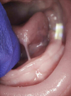 Tongue Tie Relief in Hood River, OR Tongue Tie Relief in Hood River, OR